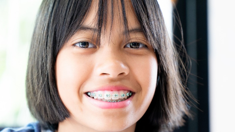 Fiksni ortodontski aparatići