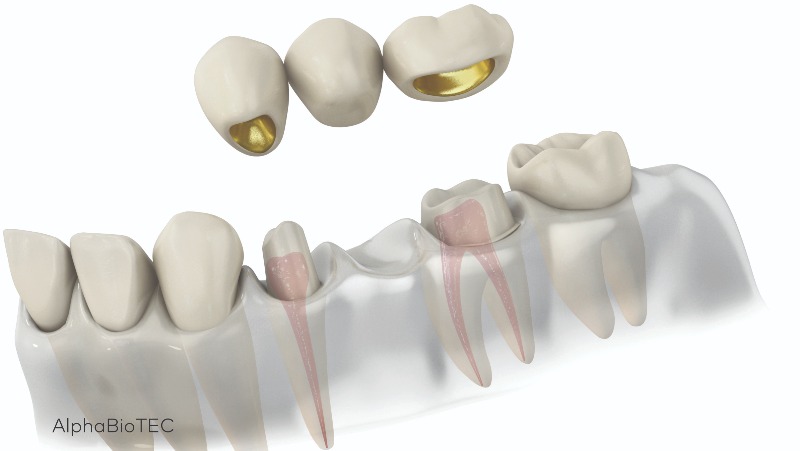 Krunice i mostovi -  Ključno rješenje za obnovu osmijeha