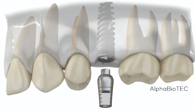 Kako izgleda postupak ugradnje dentalnih implantata? Od prve konzultacije do završne rekonstrukcije