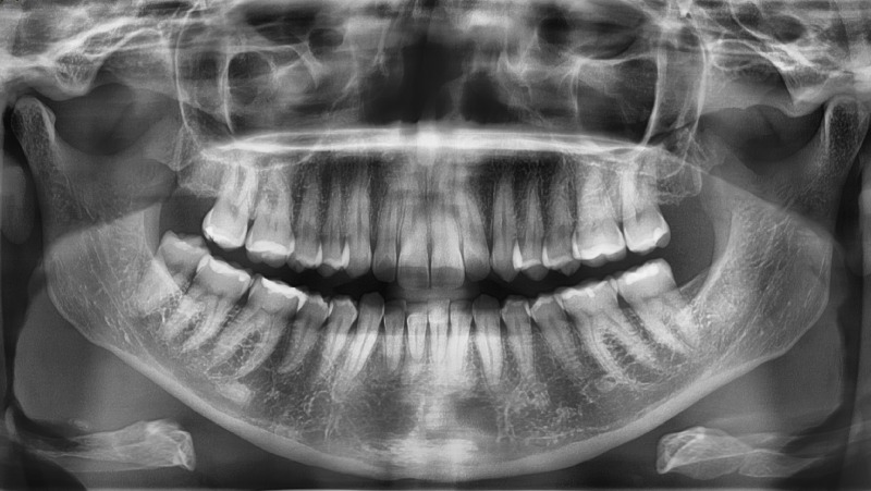 Digitalni panoramski snimak (Ortopan), RVG intraoralne snimke i CBCT 