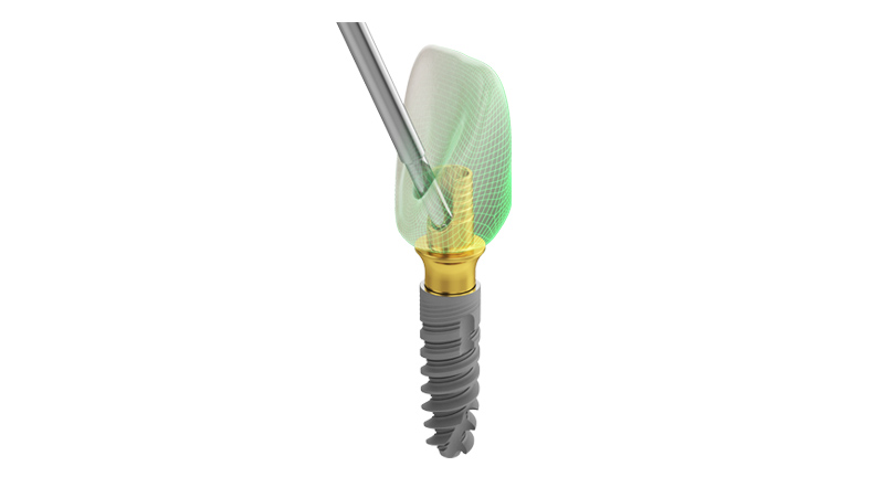 Što su dentalni implantati i što pacijent može očekivati od ugradnje dentalnih implantata?